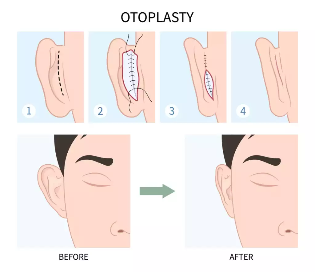 Otoplastie Tunisie