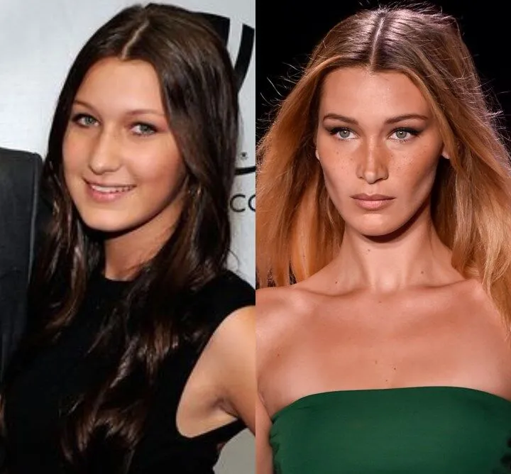 Bella Hadid avant âpres rhinoplastie 