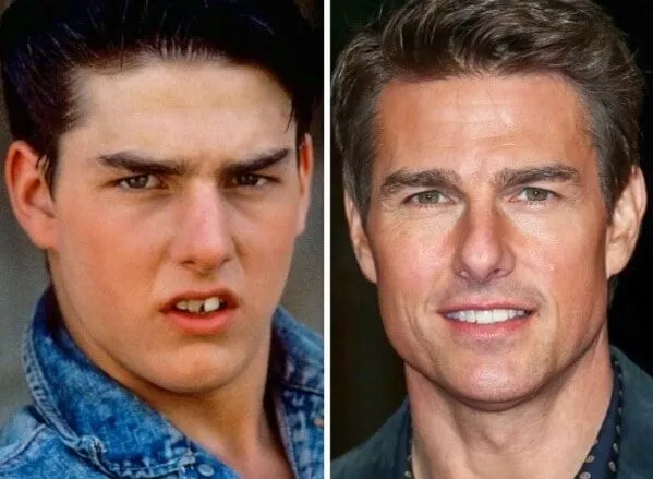Tom Cruise Avant et après la chirurgie esthétique des dents