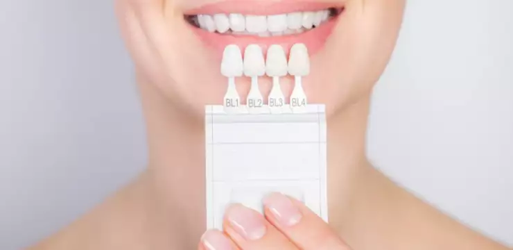 facettes dentaires