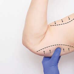 brachioplastie vs Liposuccion des bras : Guide complet pour la réduction et le remodelage des bras